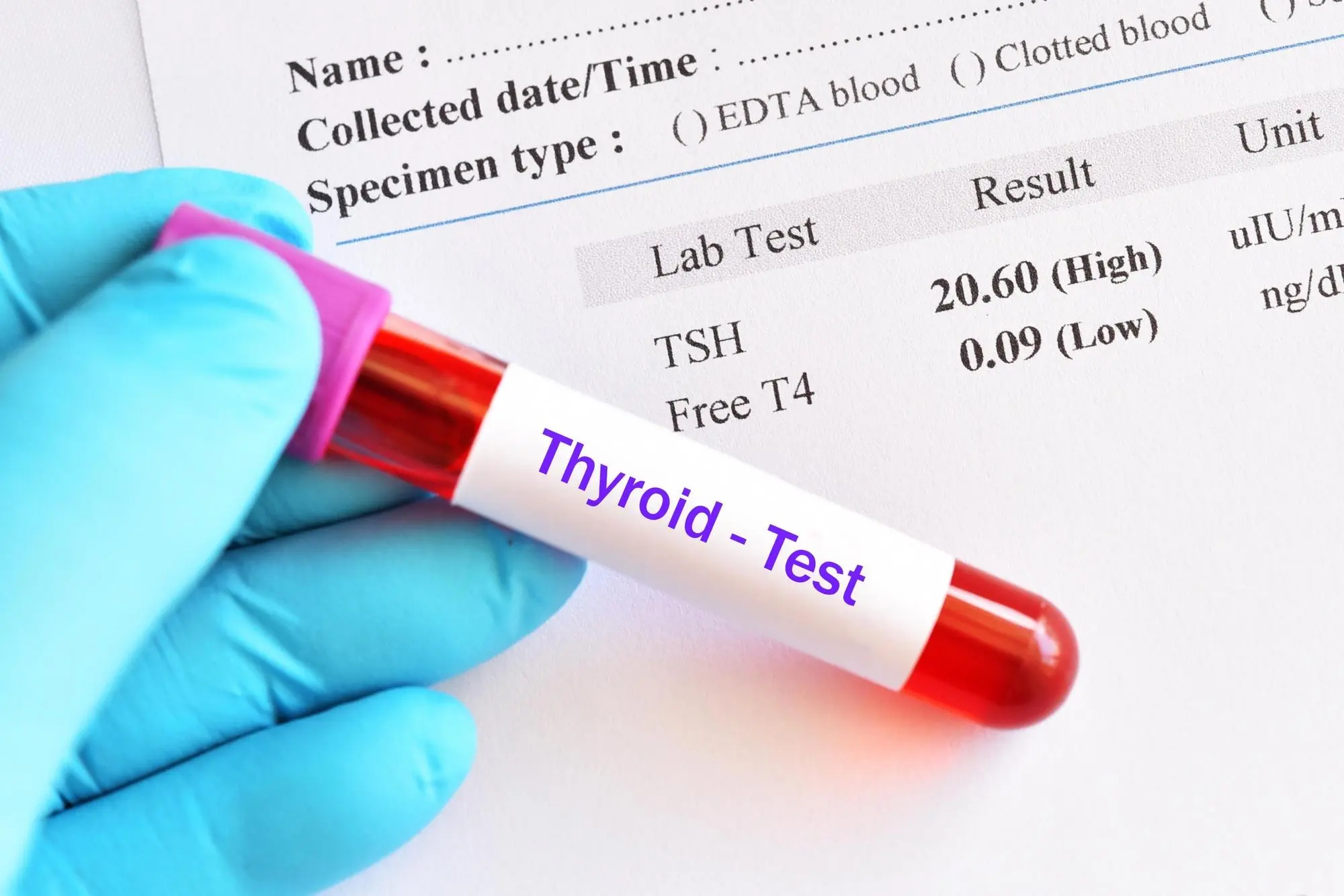 THYROID PROFILE (T3 T4 TSH )