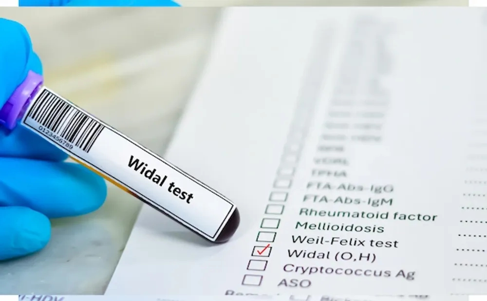 TYPHOID CARD (WIDAL IGG IGM )