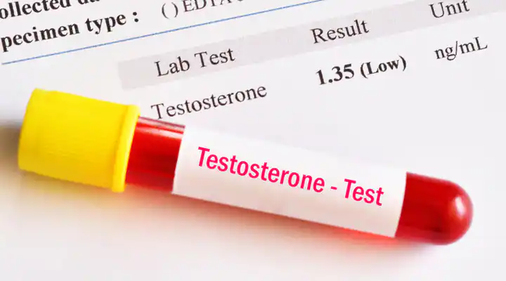 TESTOSTERONE, TOTAL